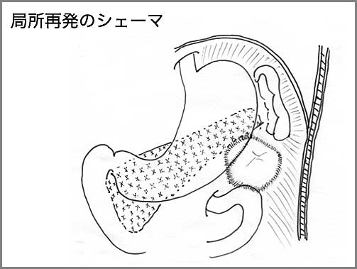 腹壁合併切除及び腹直筋による有茎筋皮弁形成移植術　シェーマ1