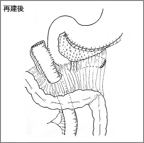 腹壁合併切除及び腹直筋による有茎筋皮弁形成移植術　シェーマ2