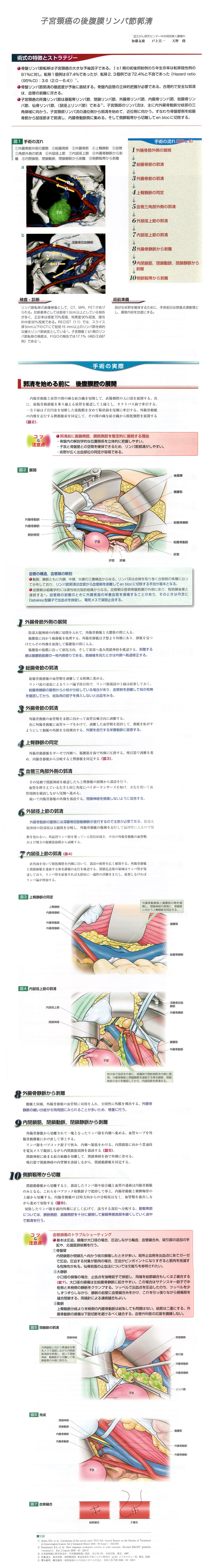 子宮頸癌の後腹膜リンパ節郭清