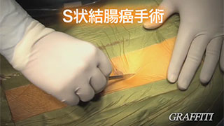 開腹によるS状結腸癌手術 開腹によるS状結腸癌手術