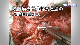 癌研手術手技 食道癌編 頸胸境界部進行食道癌の切除再建術式
監修:松原 敏樹 癌研手術手技 食道癌編_頸胸境界部進行食道癌の切除再建術式監修:松原 敏樹