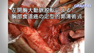 癌研手術 食道癌編
左開胸大動脈脱転による胸部食道癌の定型的郭清術式
監修:松原 敏樹 癌研手術手技 食道癌編
左開胸大動脈脱転による胸部食道癌の定型的郭清術式
監修:松原 敏樹