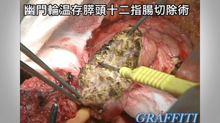 幽門輪温存膵頭十二指腸切除術 幽門輪温存膵頭十二指腸切除術