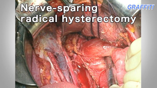 婦人科癌手術手技 Nerve-sparing radical hysterectomy 2010 ノーカット版 11分 婦人科癌手術手技 Nerve-sparing radical hysterectomy 2010 ノーカット版 11分
