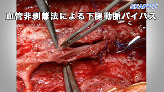 本編 血管非剥離法による下腿動脈バイパス 28分 本編 血管非剥離法による下腿動脈バイパス 28分