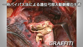 一時バイパス法による遠位弓部大動脈瘤の手術 一時バイパス法による遠位弓部大動脈瘤の手術