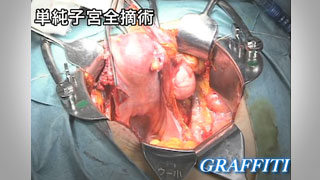 婦人科がんの手術基本手技 1.単純子宮全摘術 ノーカット版 20分 婦人科がんの手術基本手技1.単純子宮全摘術 ノーカット版 20分