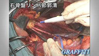婦人科がんの手術基本手技 2.右骨盤リンパ節郭清 ノーカット版 18分 婦人科がんの手術基本手技 2.右骨盤リンパ節郭清 ノーカット版 18分
