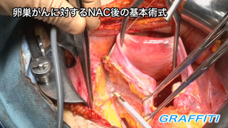 婦人科がんの手術基本手技 3 .卵巣がんに対するNAC後の基本術式 ノーカット版16分 婦人科がんの手術基本手技 3 .卵巣がんに対するNAC後の基本術式 ノーカット版 16分
