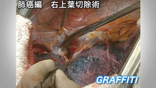 後側方切開のよる右上葉切除術  監修：中川　健（癌研究会附属病院呼吸器外科部長・現 がん研有明病院名誉院長）