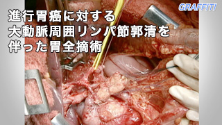 癌研手術手技
食道癌編頸胸境界部進行食道癌の切除再建術式
監修：松原 敏樹