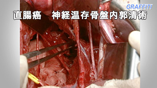 癌研手術手技　直腸癌編　神経温存骨盤内郭清術 監修：高橋 孝（癌研究会附属病院消化器外科部長）